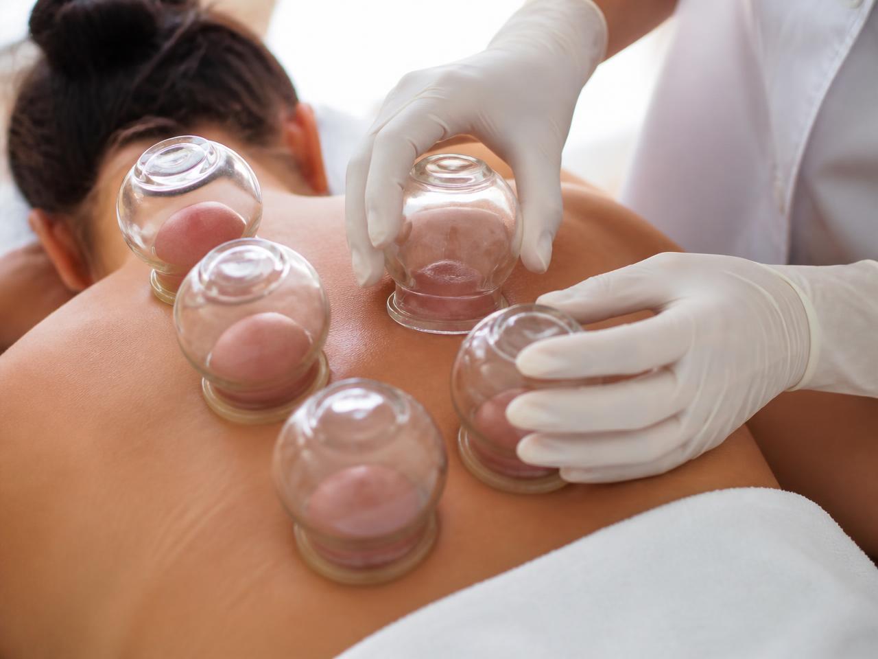 Cupping therapy being applied to a client's back